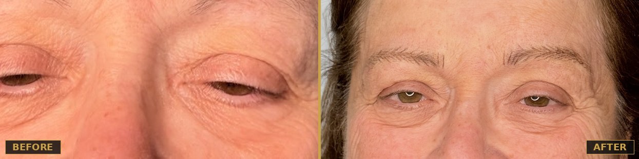 Before and after brow enhancement, hair stroke technique