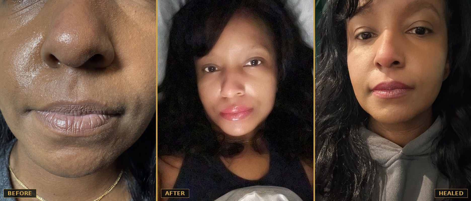 Before, after, and healed lip neutralization result